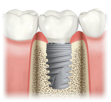 Dental Implants For Kids