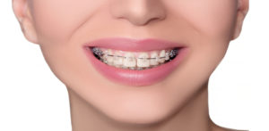 clear-aligners-invisalign-ahmedabad -bestdentist-drpanktipatel-drniravpatel-bestorthodontist-bestdentalclinic-9