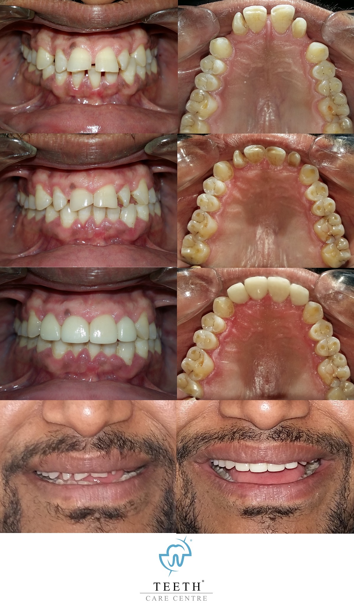 clear aligner ahmedabad crown smile make over dr pankti patel teeth care centre india