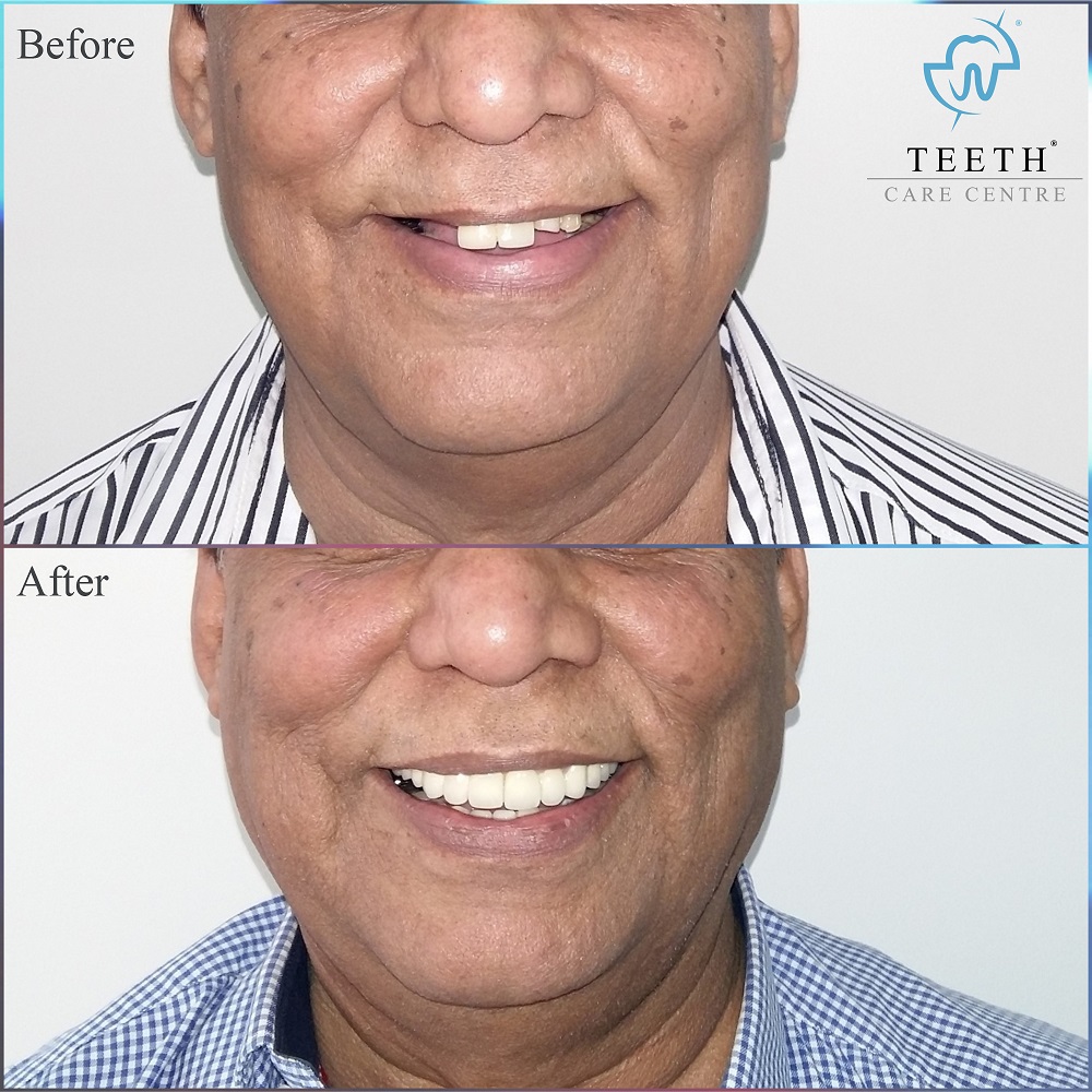 dental implants ahmedabad india fixed teeth denture bridge nobel biocare all on 4 dentist titanium