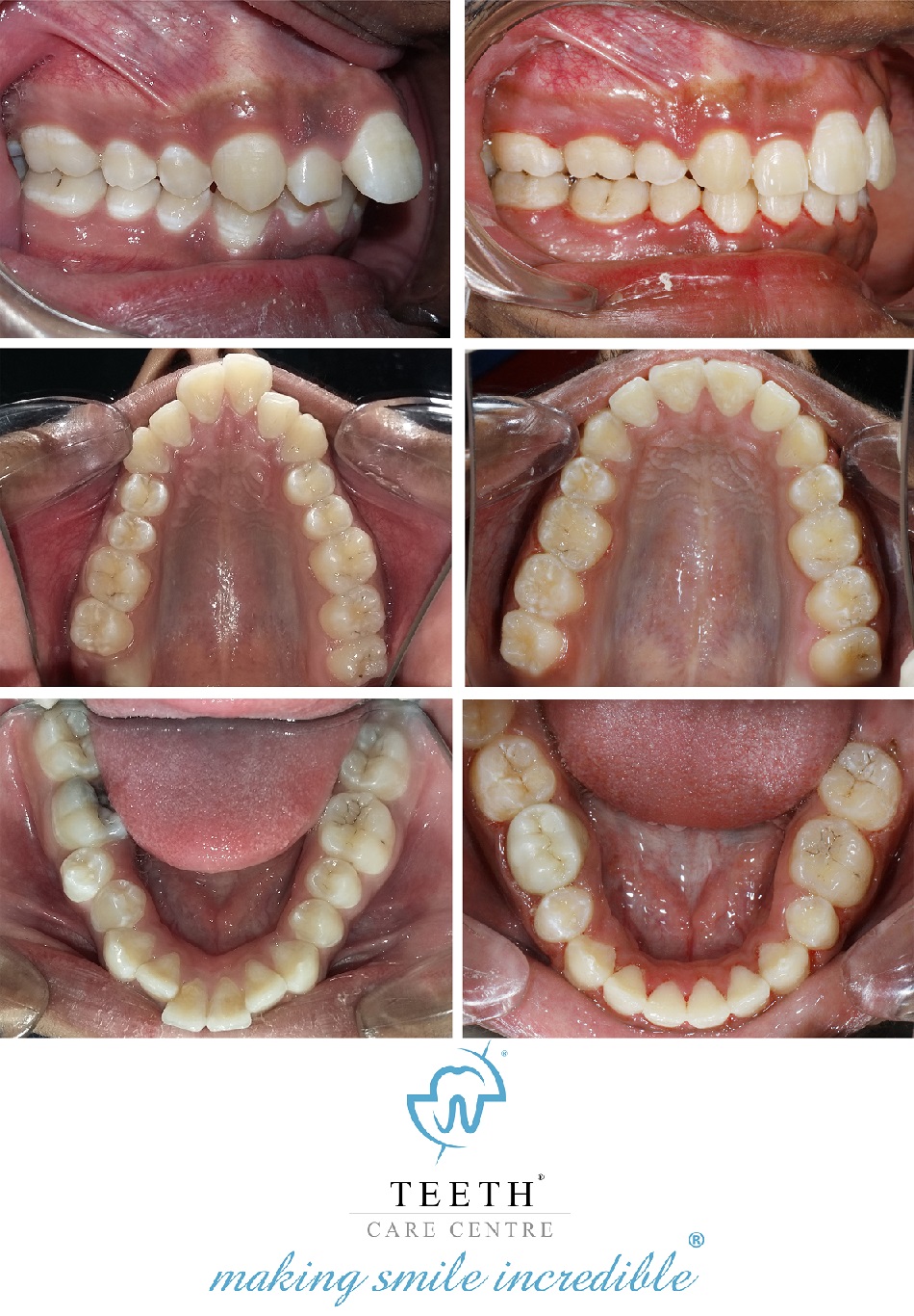 braces treatment invisalign aligner dr nirav patel orthodontist ahmedabad invisible braces