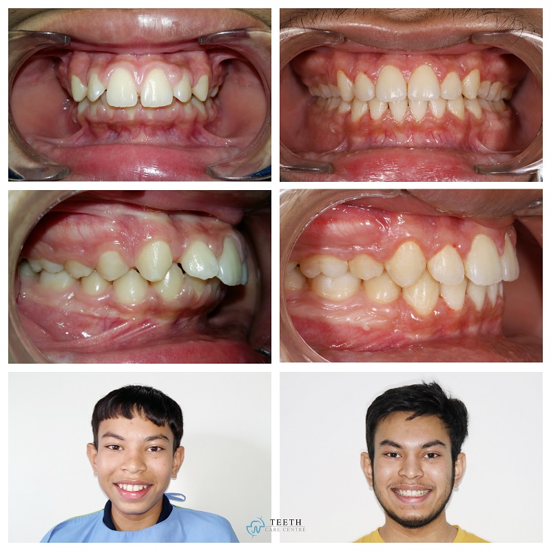 Invisalign Clear Aligner Clinic in Ahmedabad India – Teeth Care Centre®  Dental Hospital