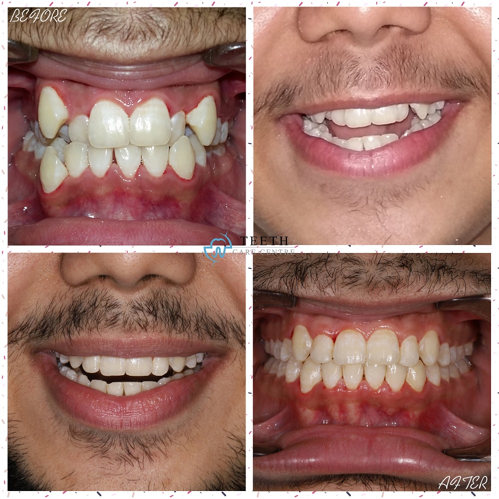 damon braces ahmedabad orthodontist dr nirav patel satellite paldi thaltej best braces specialist invisalign kline flash aligners clear aligners teeth care centre