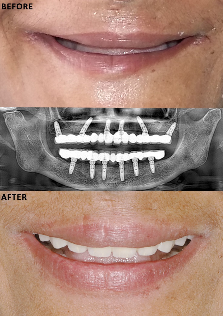 dental implant india ahmedabad full mouth teeth restoration all on 4 fixed teeth denture teeth care centre implantologist best dentist dental clinic satellite