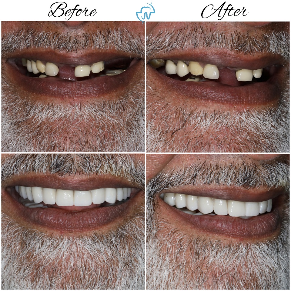 dental implant ahmedabad dentist india best top teeth care centre