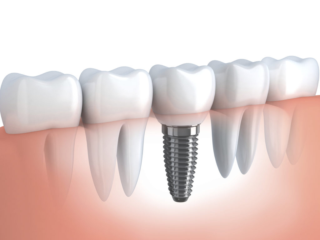 Affordable dental implants – Teeth Care Centre® Dental Hospital